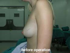 plastic-surgery-breast-augmentation 